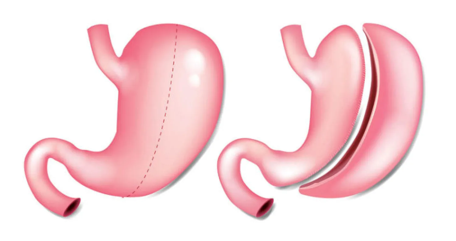 جراحات إنقاص الوزن للمراهقين