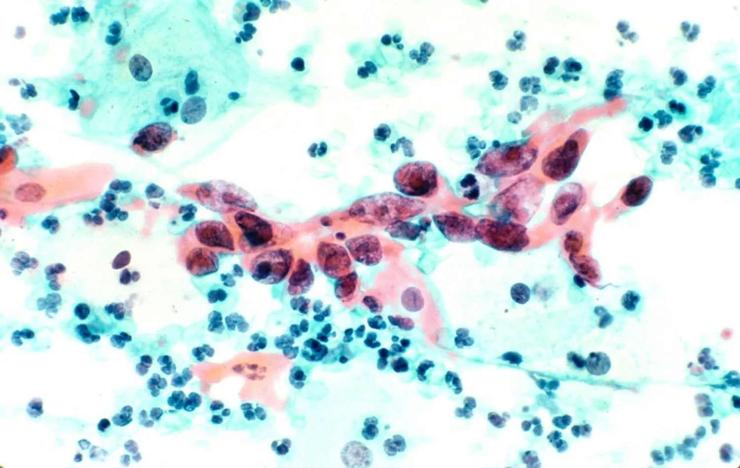 Cervical cancer cells. Reuters/NCI/handout
