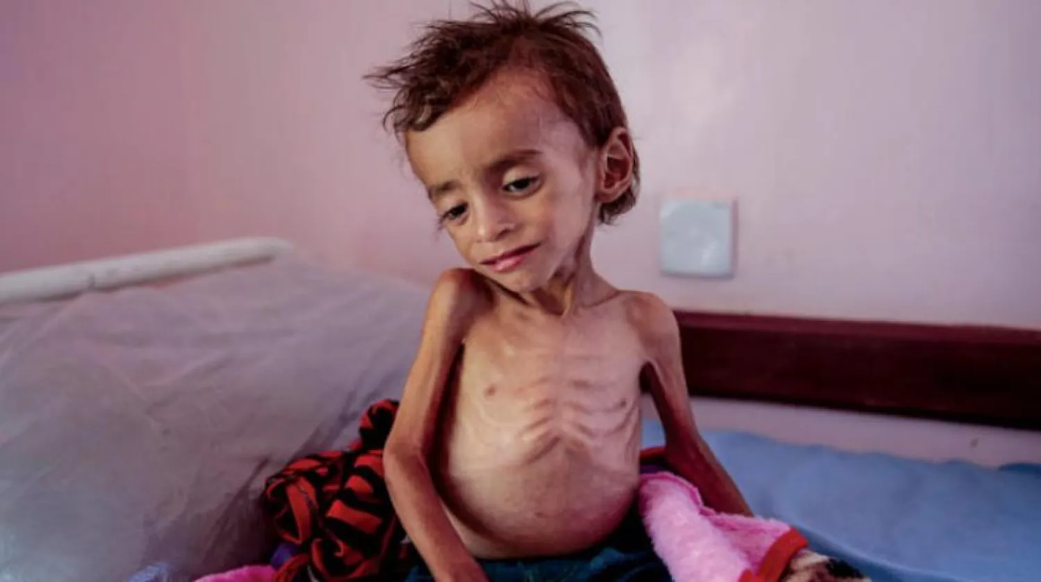 Yemenli çocuk, açlık ve hastalıkla boğuşuyor (AP)