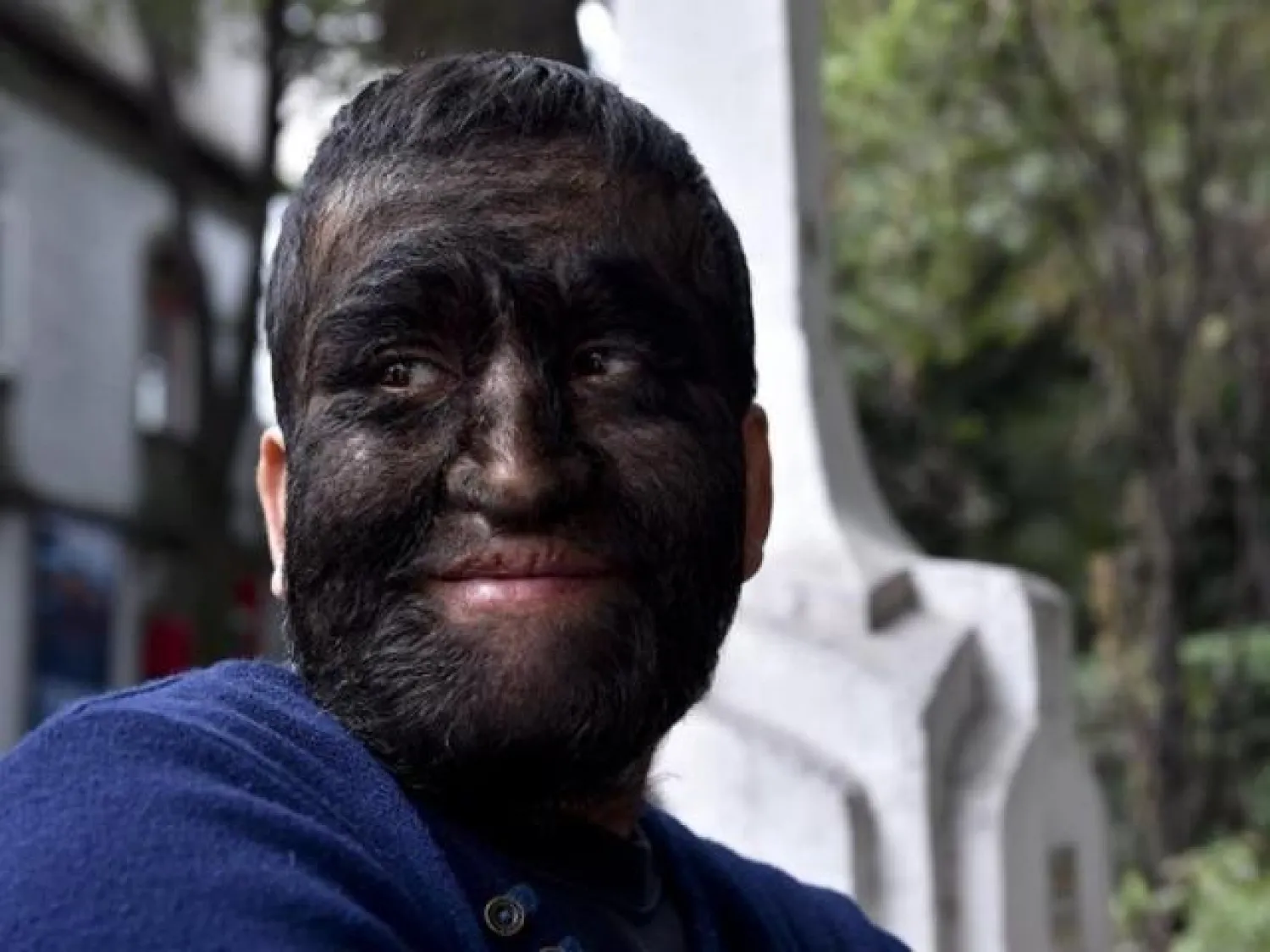 «متلازمة الذئب» هي حالة مرضية تشهد فيها بعض الأماكن في الجسم نموًا مفرطًا للشعر (أرشيف - أ.ف.ب)