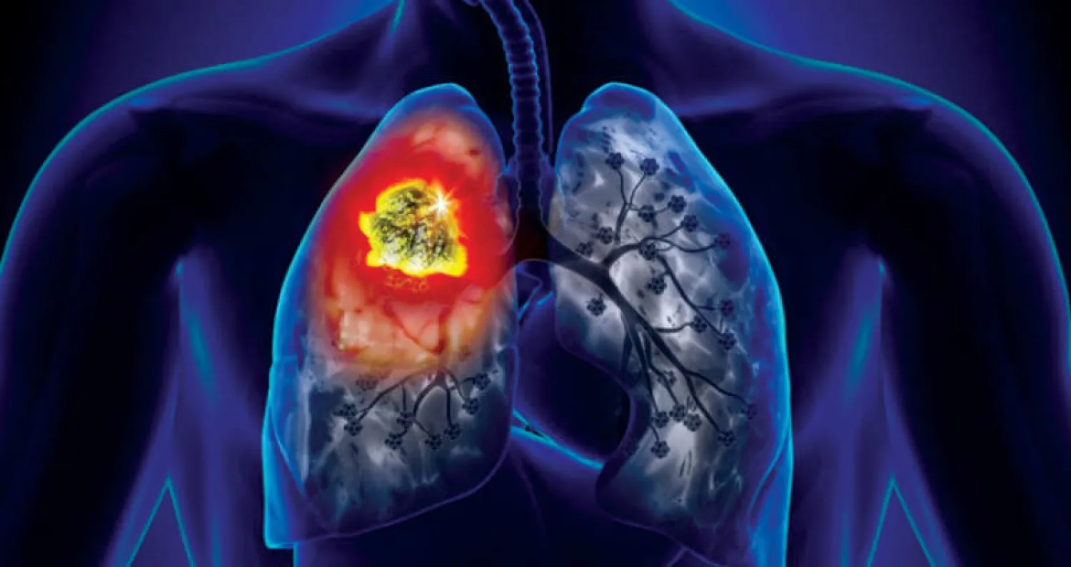 عقار جديد لعلاج سرطان الرئة يحقق نجاحاً بنسبة 54 %