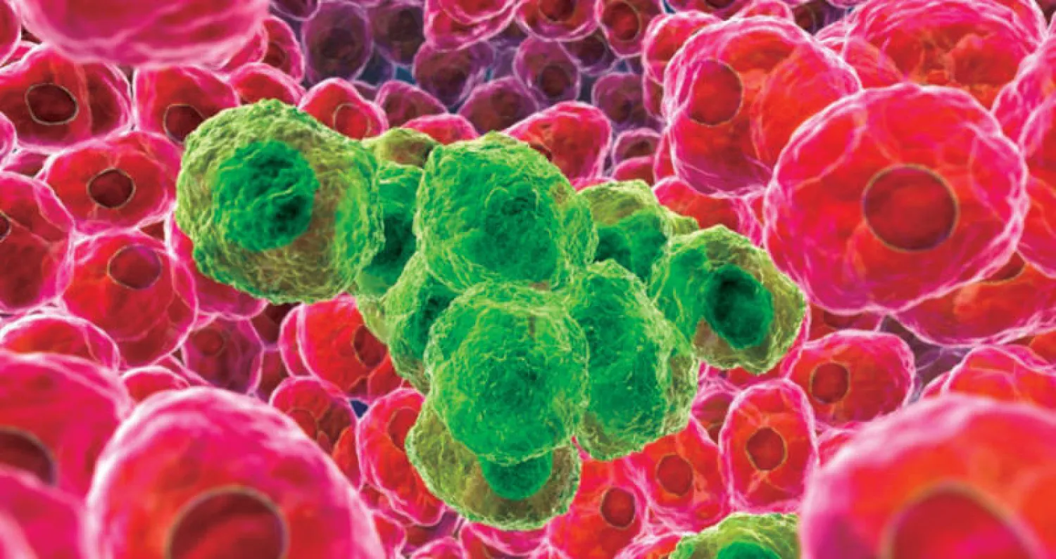 باحثون يرجحون ارتباط العقم بسرطان البروستاتا