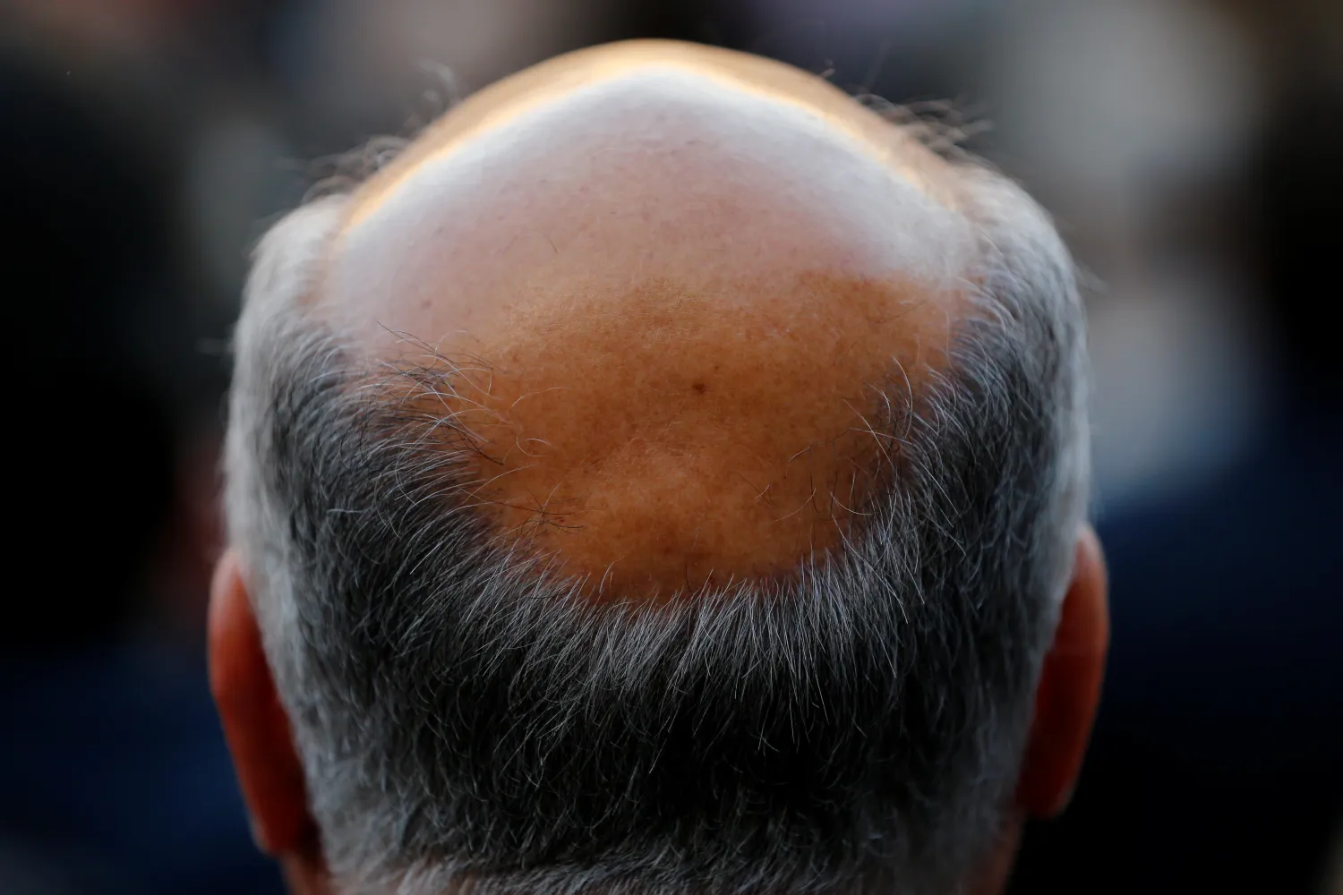 A man with baldness is seen in Seville, southern Spain, April
6, 2016. Photo: Reuters/ Marcelo del Pozo