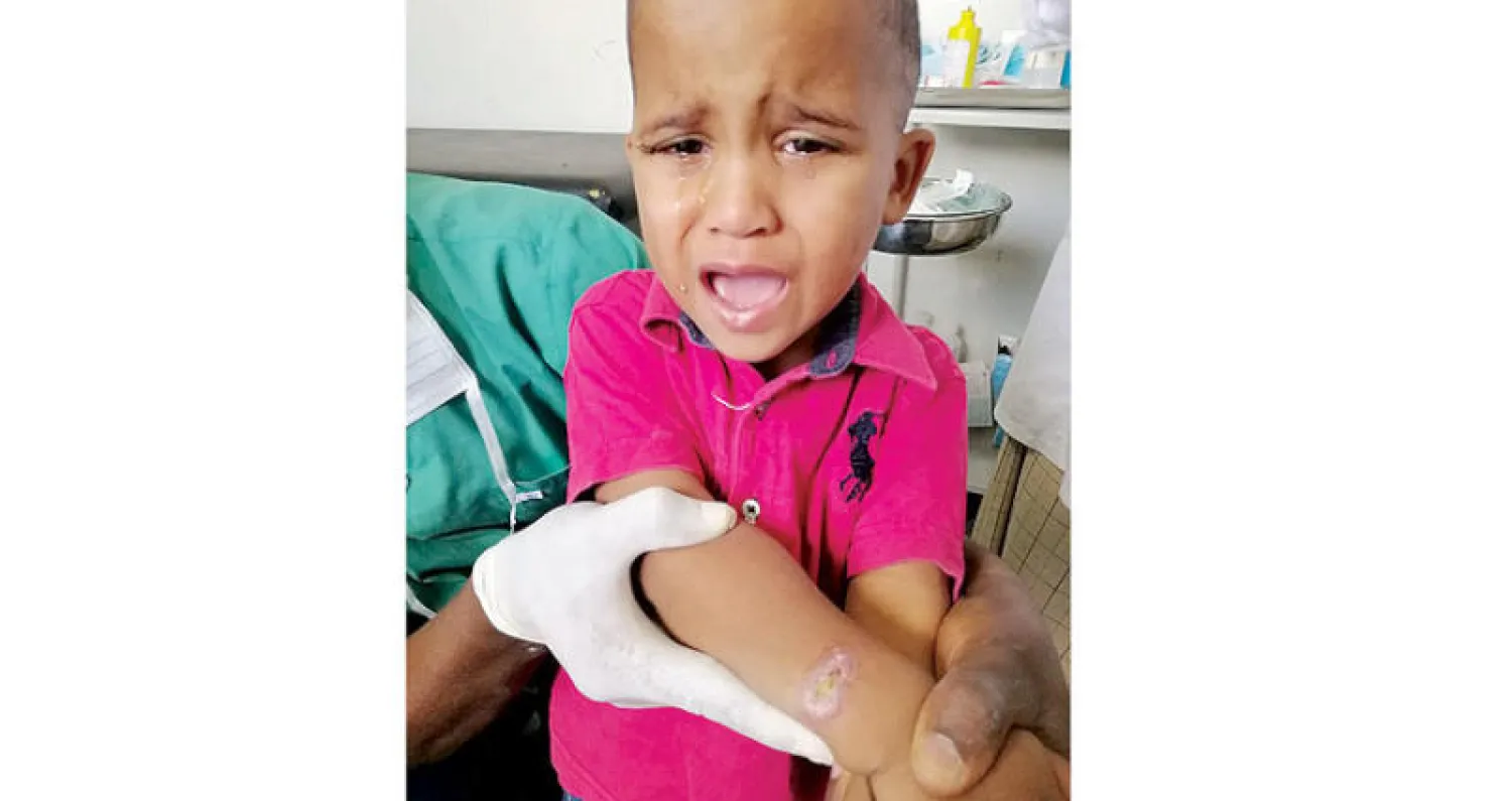 طفلة تتلقى العلاج من مرض اللشمانيا في مستشفى تاورغاء