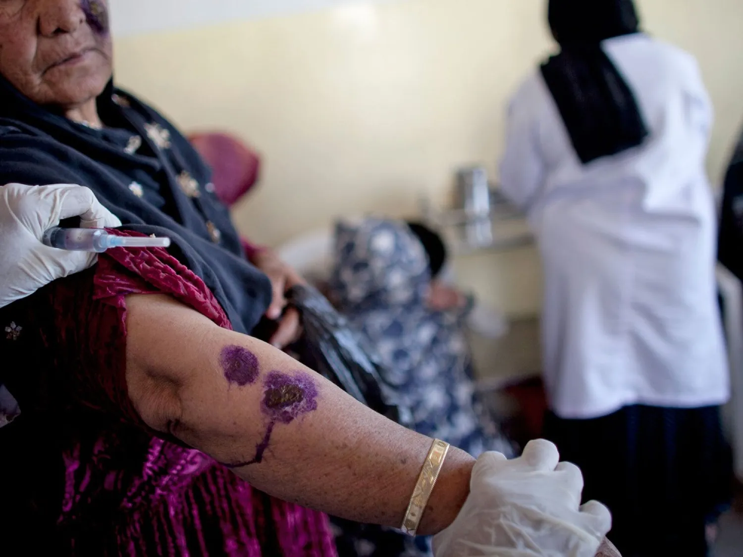 A woman shows signs of CL on her arm. (Getty Images)