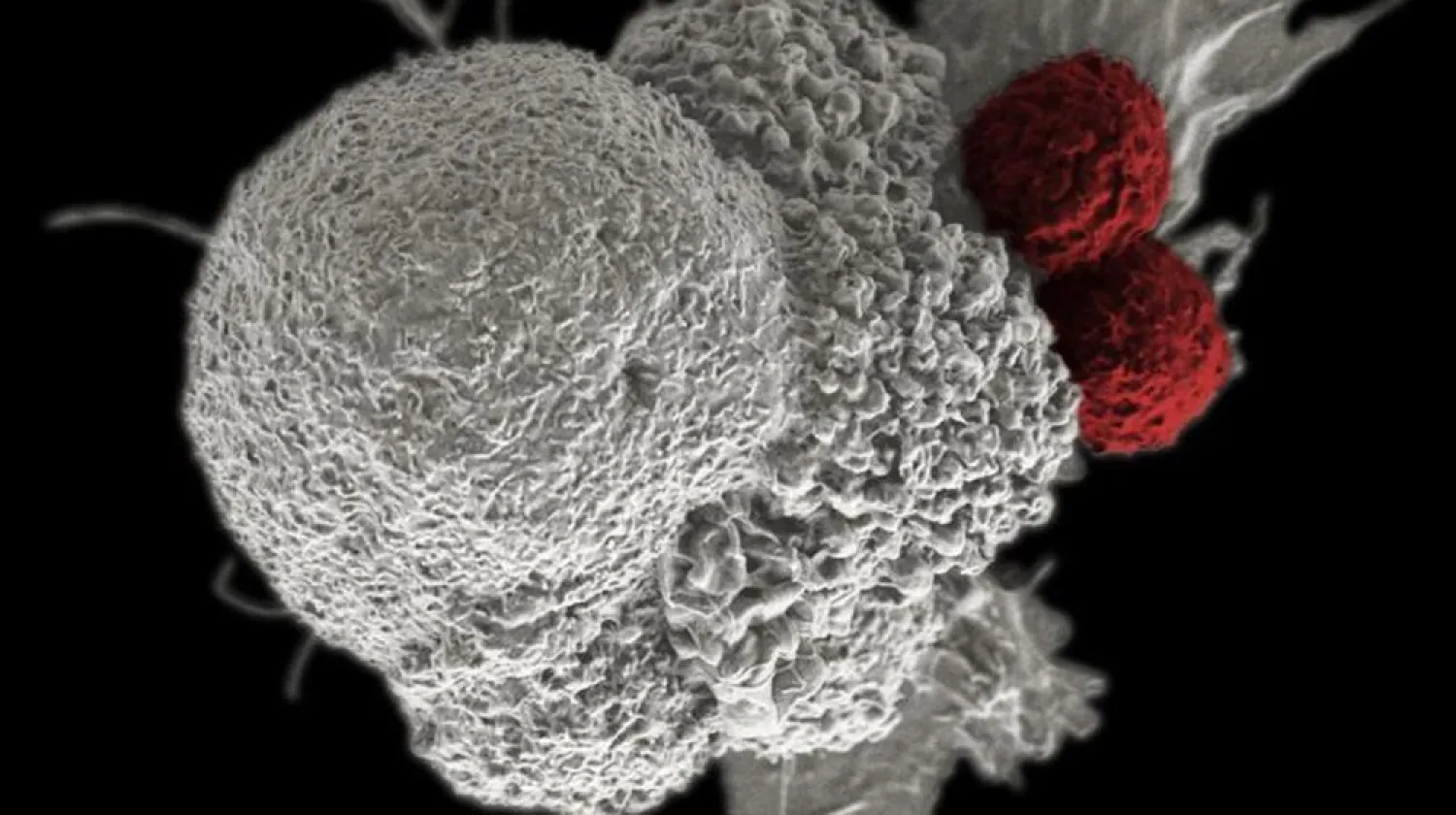 A cancer cell (white) being attacked by two cytotoxic T cells (red), part of a natural immune response triggered by immunotherapy. (Reuters)