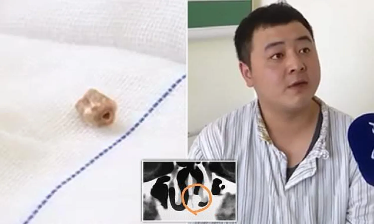 السن قبل وبعد إزالتها من أنف تشانغ بينشنغ (ديلي ميل)