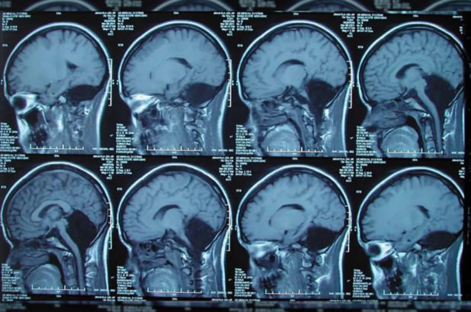 صور الأشعة المقطعية الخاصة بالشابة الصينية (نيويورك بوست)