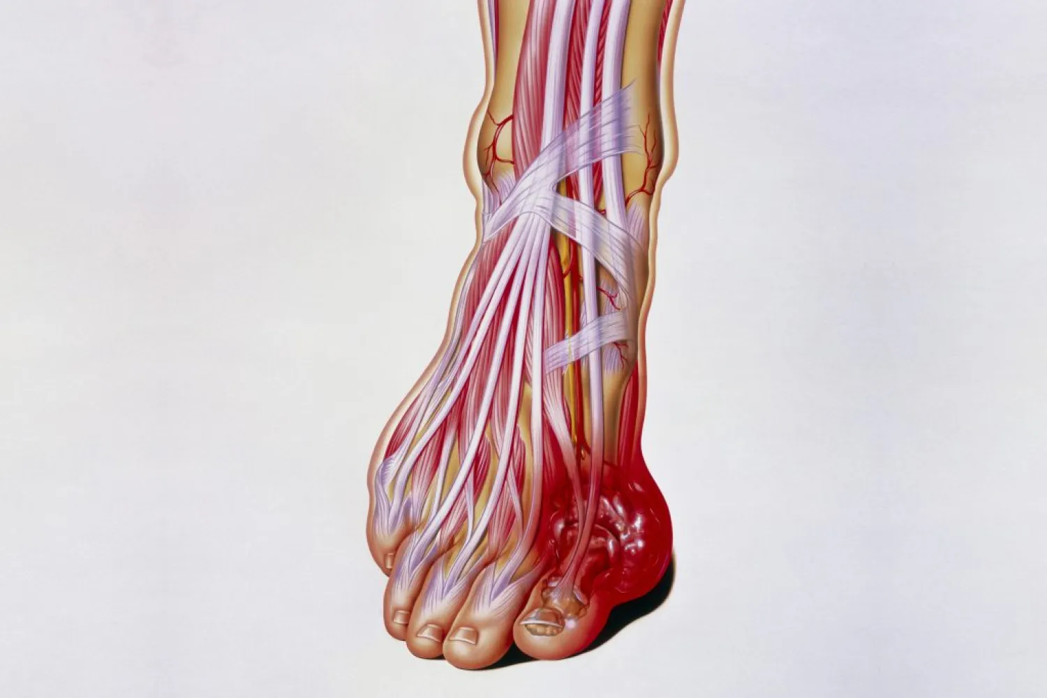 he internal anatomy of a foot, showing a tophus (swelling) due to gout. (John Bavosi/Science Photo Library via Getty Images)