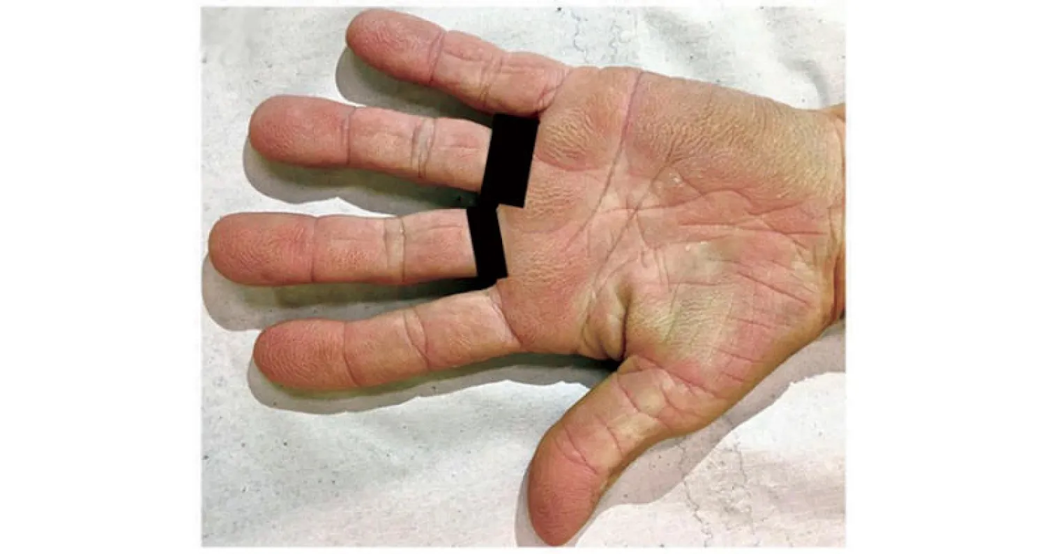 يد مريضة مصابة بالاضطراب الجلدي النادر
