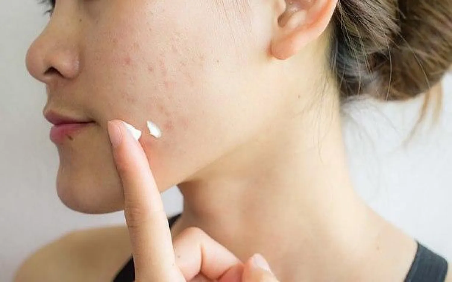 الفتاة أصيبت بحمى وانتفخت عينها اليمنى بشدة بعد فقع البثور (ديلي ميل)