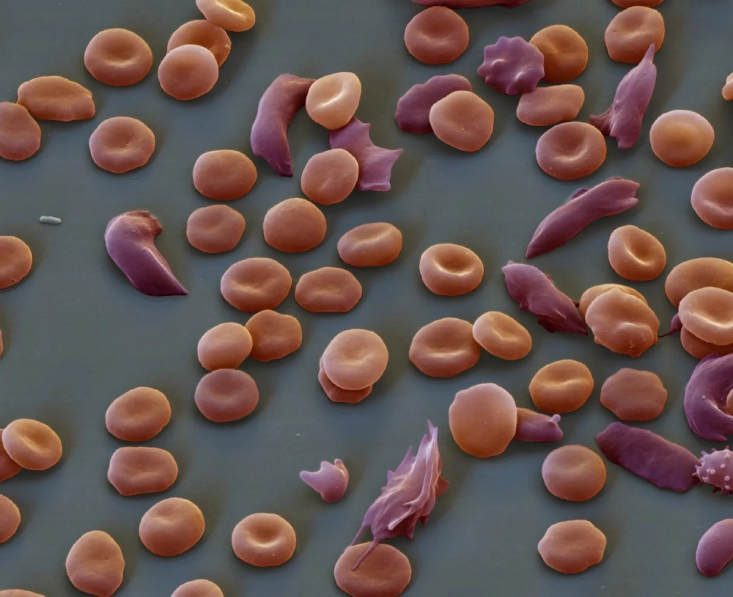 Red blood cells in sickle-cell disease have a characteristic elongated shape. Image: Junior D. Kannah/AFP/Getty Images