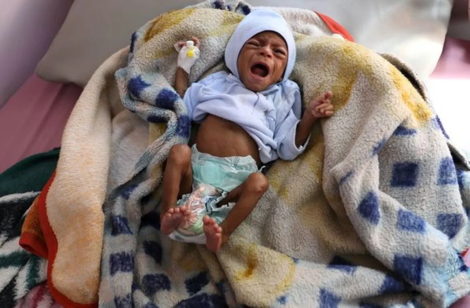 A malnourished child cries at the malnutrition treatment ward of al-Sabeen hospital in Sanaa, Yemen October 27, 2020. REUTERS/Khaled Abdullah 

