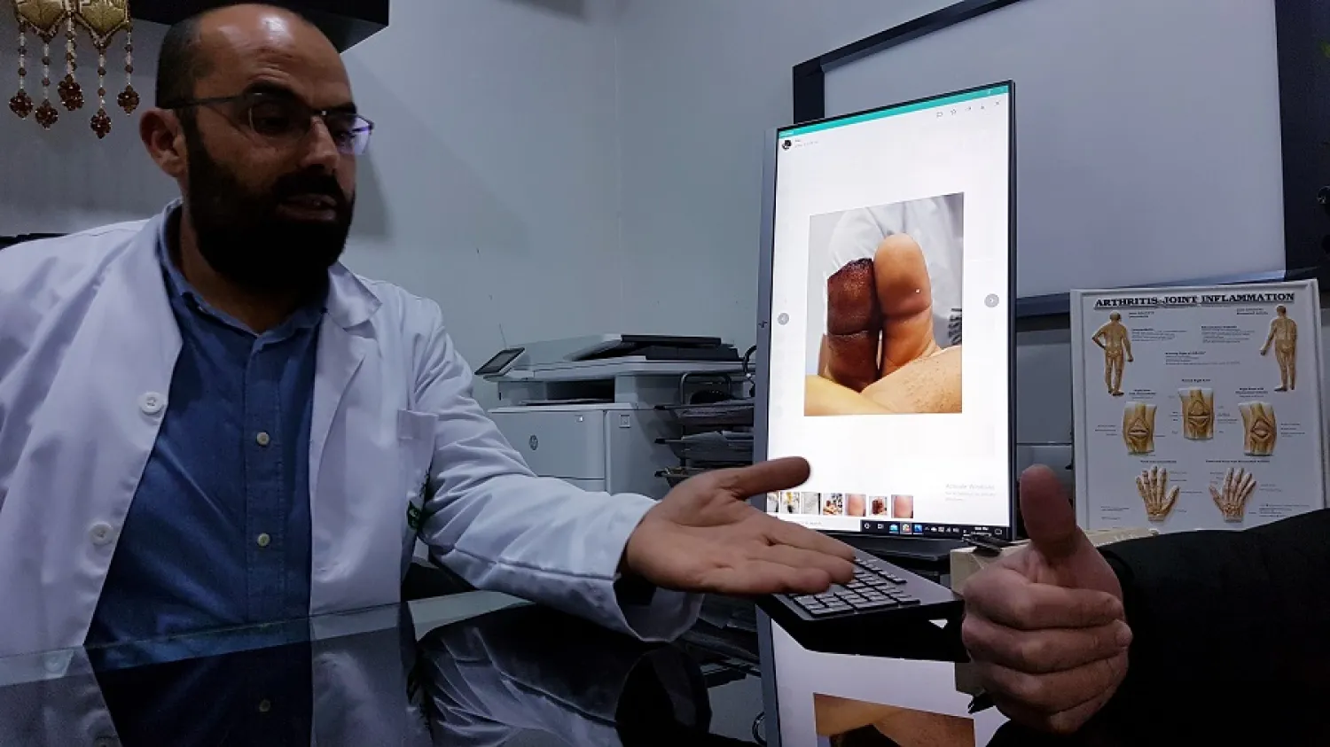 Ramallah şehrinden Filistinli doktor Salih Rıdvan, 2016 yılında kesilmiş parmak uçlarını düzeltme çalışmalarına başladı
