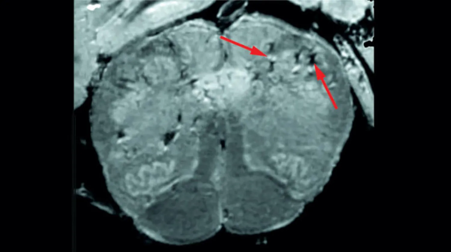 الباحثون وجدوا علامات لتلف الأوعية الدموية في المخ (المعاهد الوطنية للصحة بأميركا)