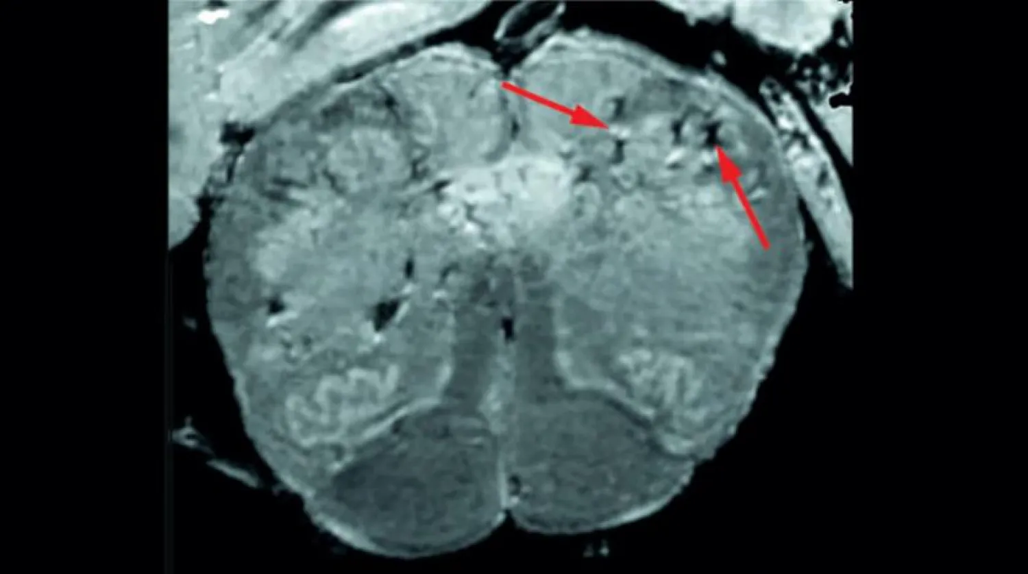 Araştırmacılar beyindeki kan damarlarında hasar belirtileri buldular (ABD Ulusal Sağlık Enstitüsü)