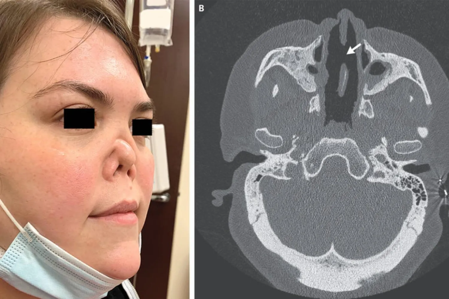 Bağışıklık sisteminin kendi dokularına saldırmasına "otoimmün hastalıklar" ismi veriliyor (The New England Journal of Medicine)
