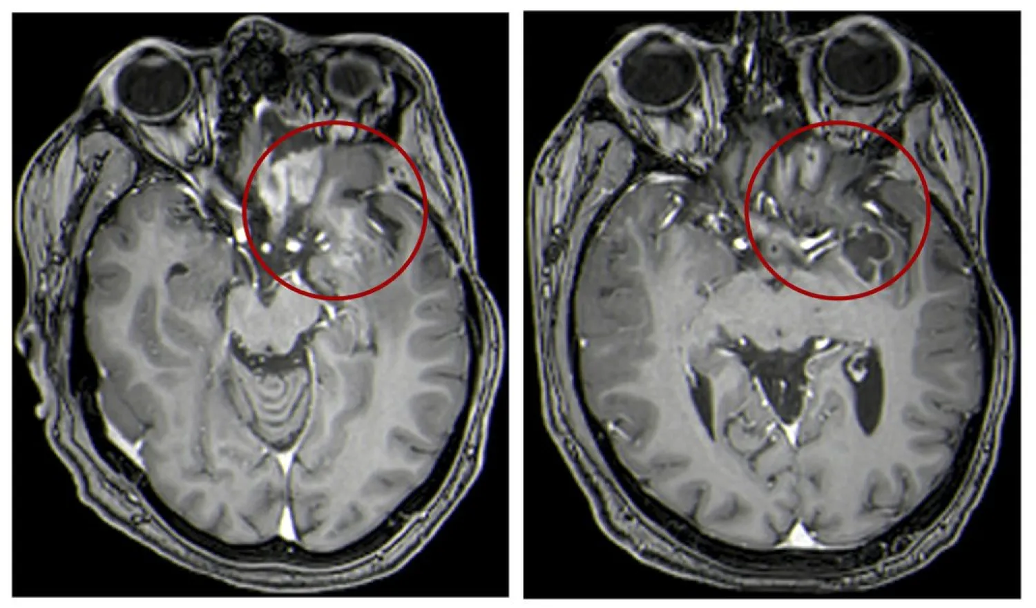 This combination of MRI images provided by the University of Alabama in April 2021 shows scans of a child with a brain tumor, before and after a treatment that involves using viruses to spur an immune system response to the cancerous cells. (UAB via AP)