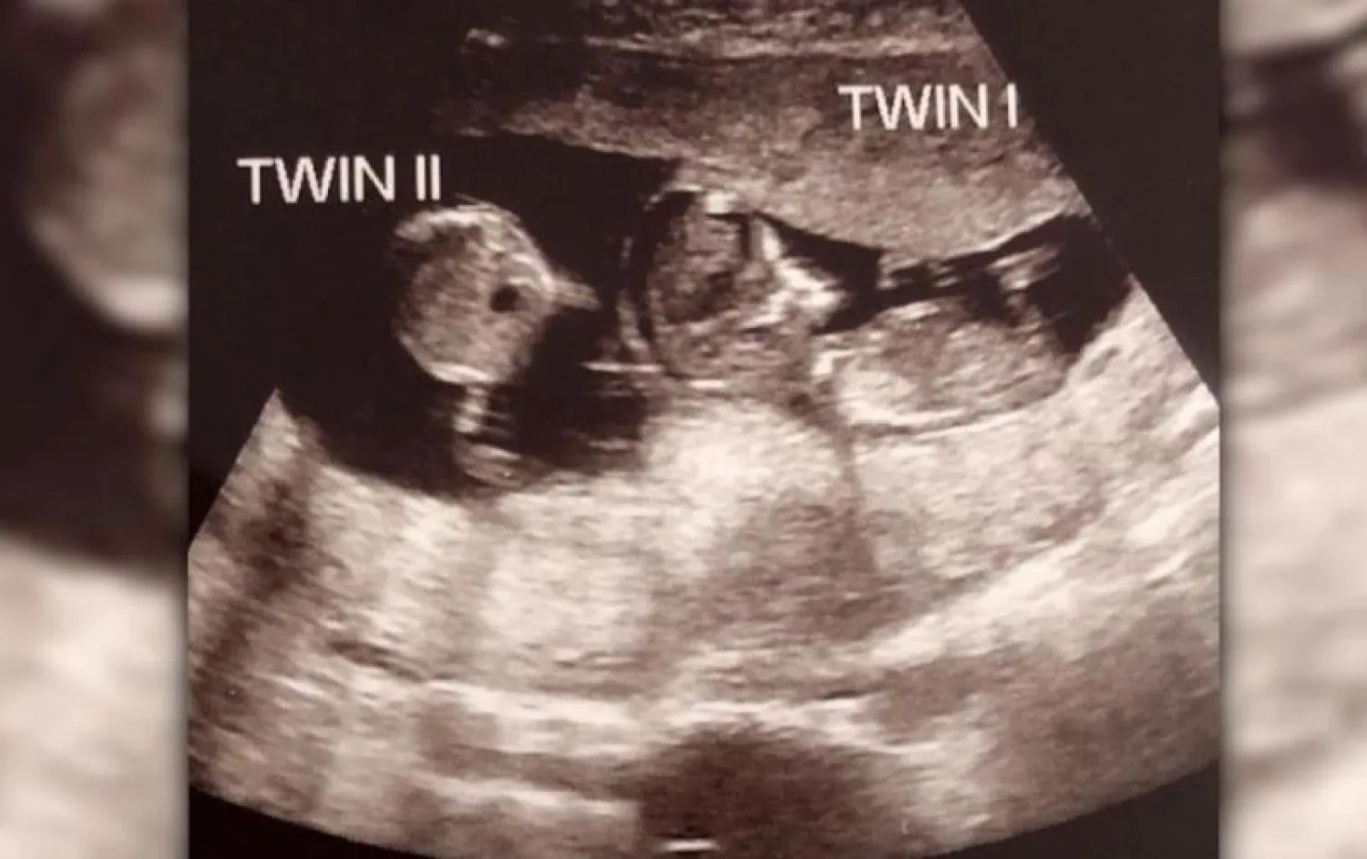 فحص بالموجات فوق الصوتية يُظهر الجنينين معاً (سي إن إن)