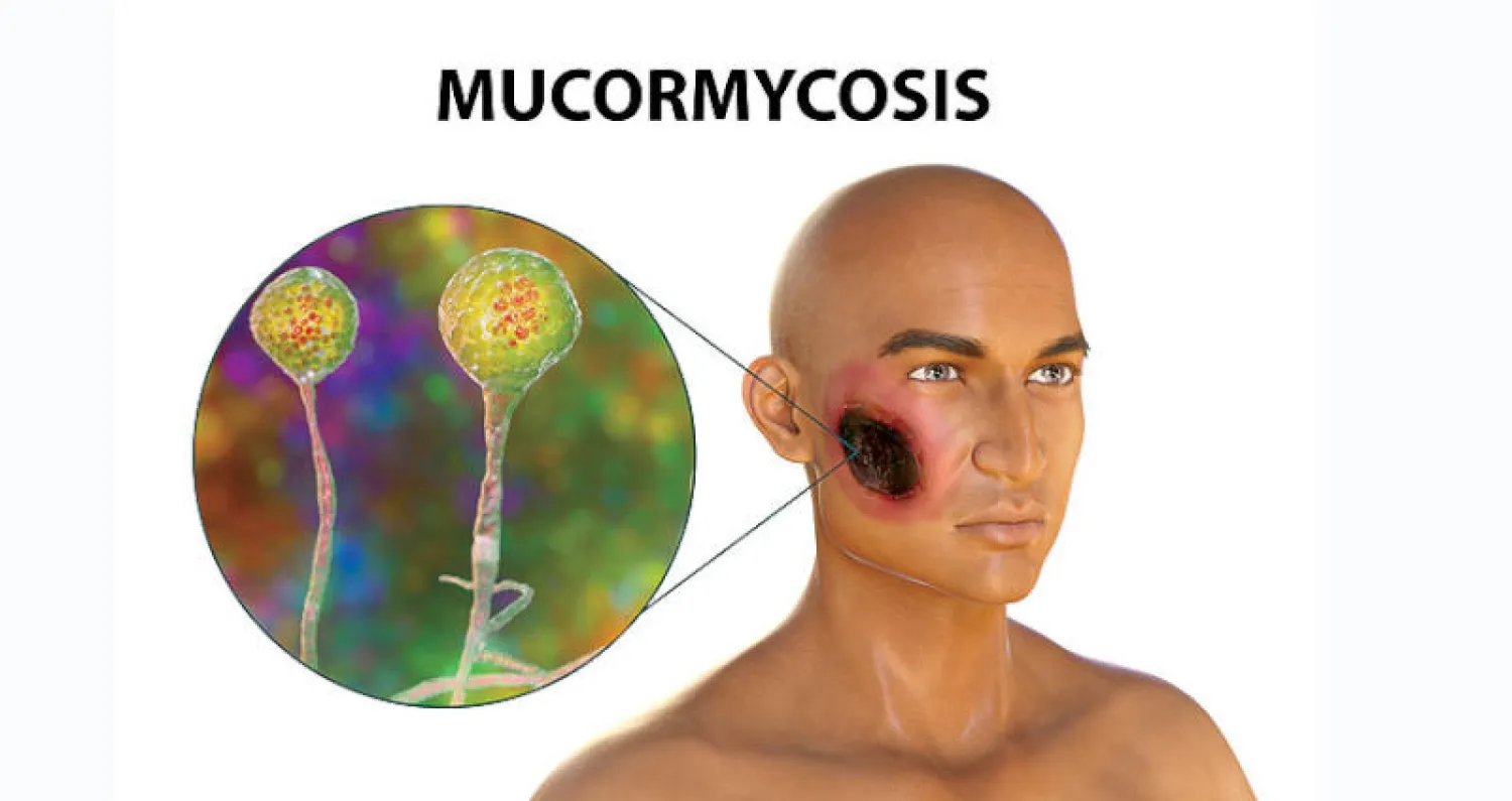 «الفطر الأسود»... إصابات متزايدة بين المصابين بـ«كوفيد ـ 19»