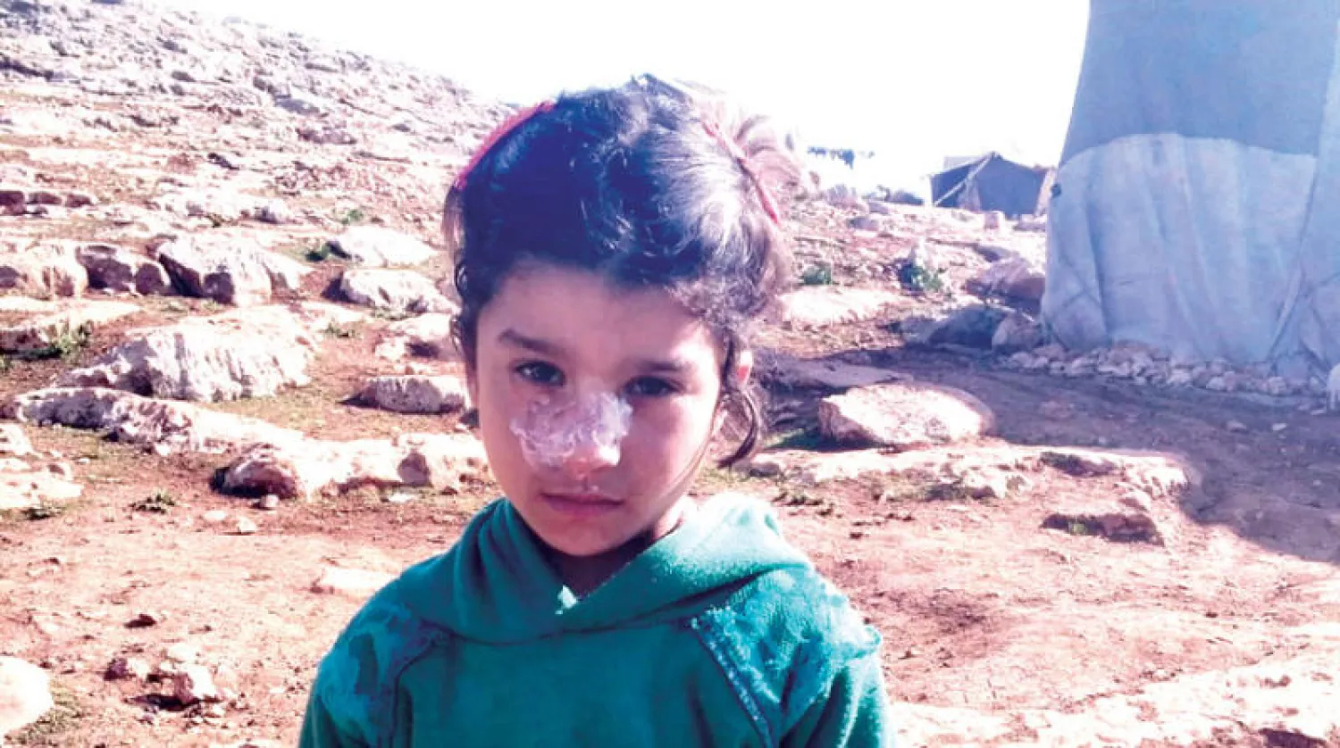 طفلة نازحة مصابة بحبة الليشمانيا في أحد مخيمات الشمال السوري (الشرق الأوسط)