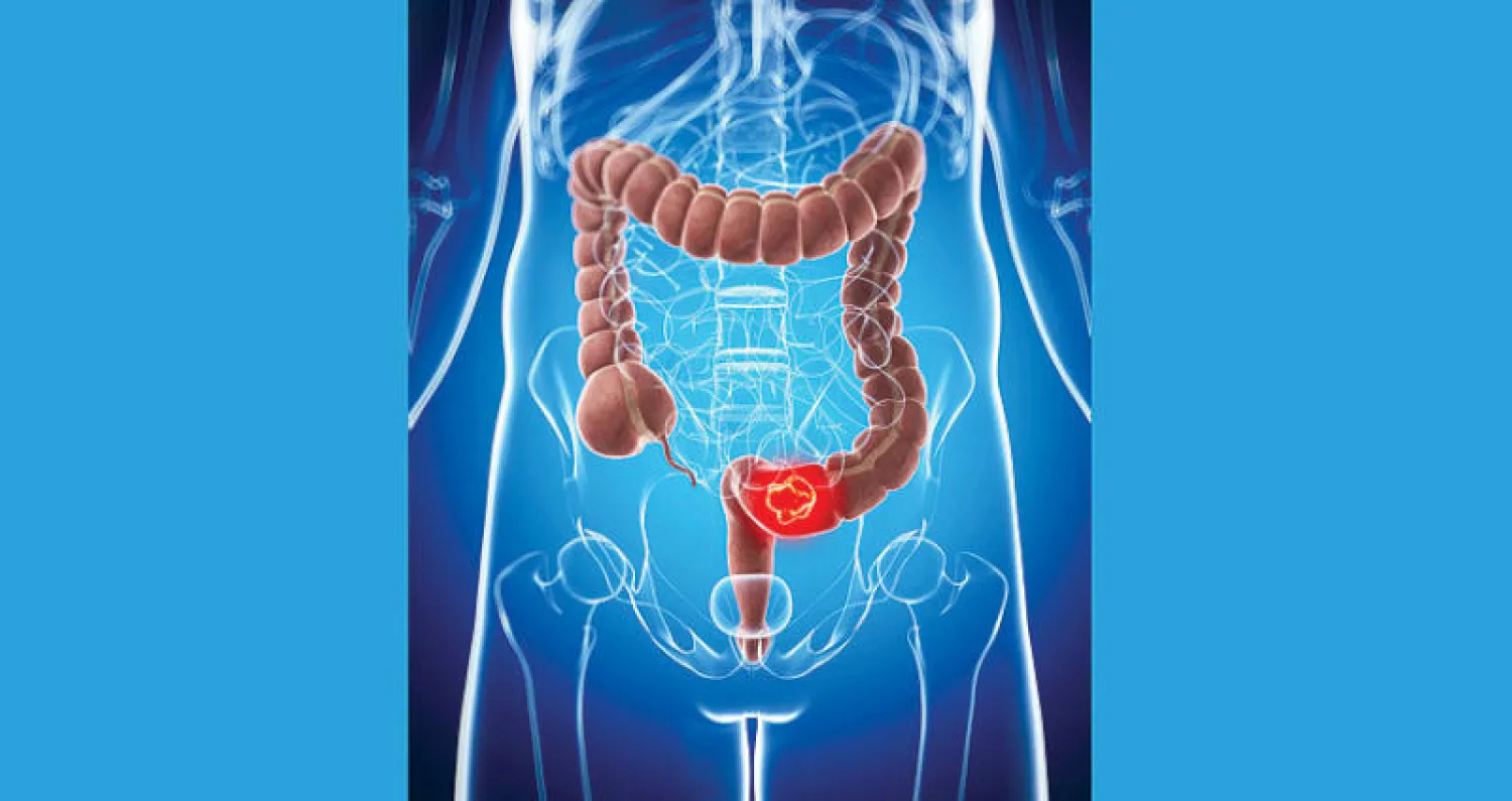 توصيات طبية للوقاية من سرطان القولون والمستقيم