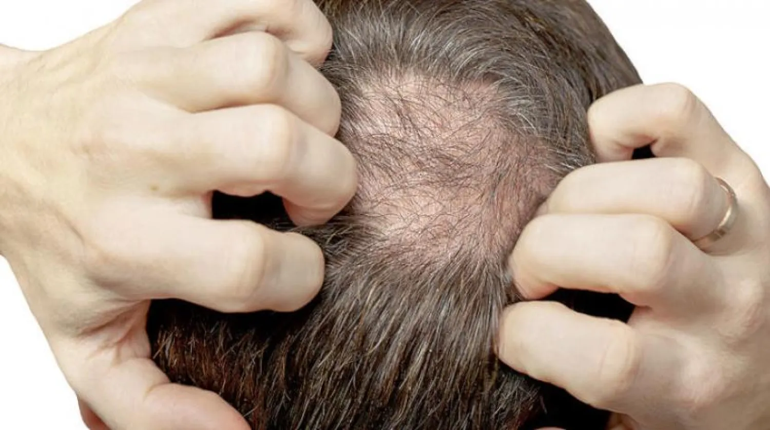 Saç dökülmesi olan bir adam (Shutterstock)