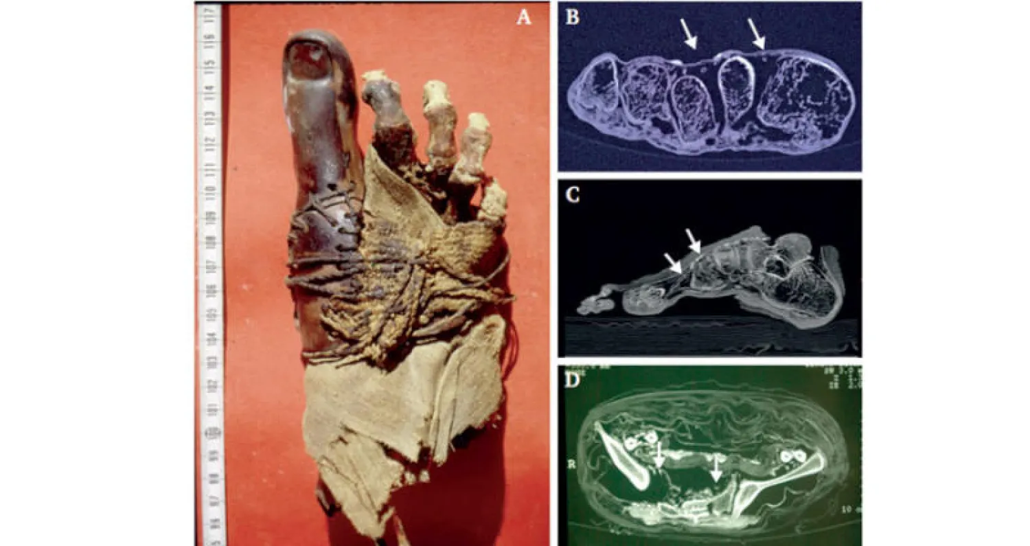 طرف صناعي بالإصبع الكبير نتيجة الإصابة بتصلب الشرايين المحيطي