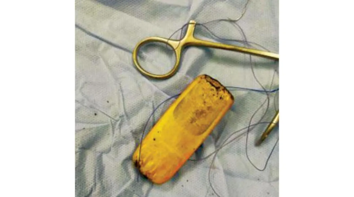 The cellphone removed from the stomach of the inmate 