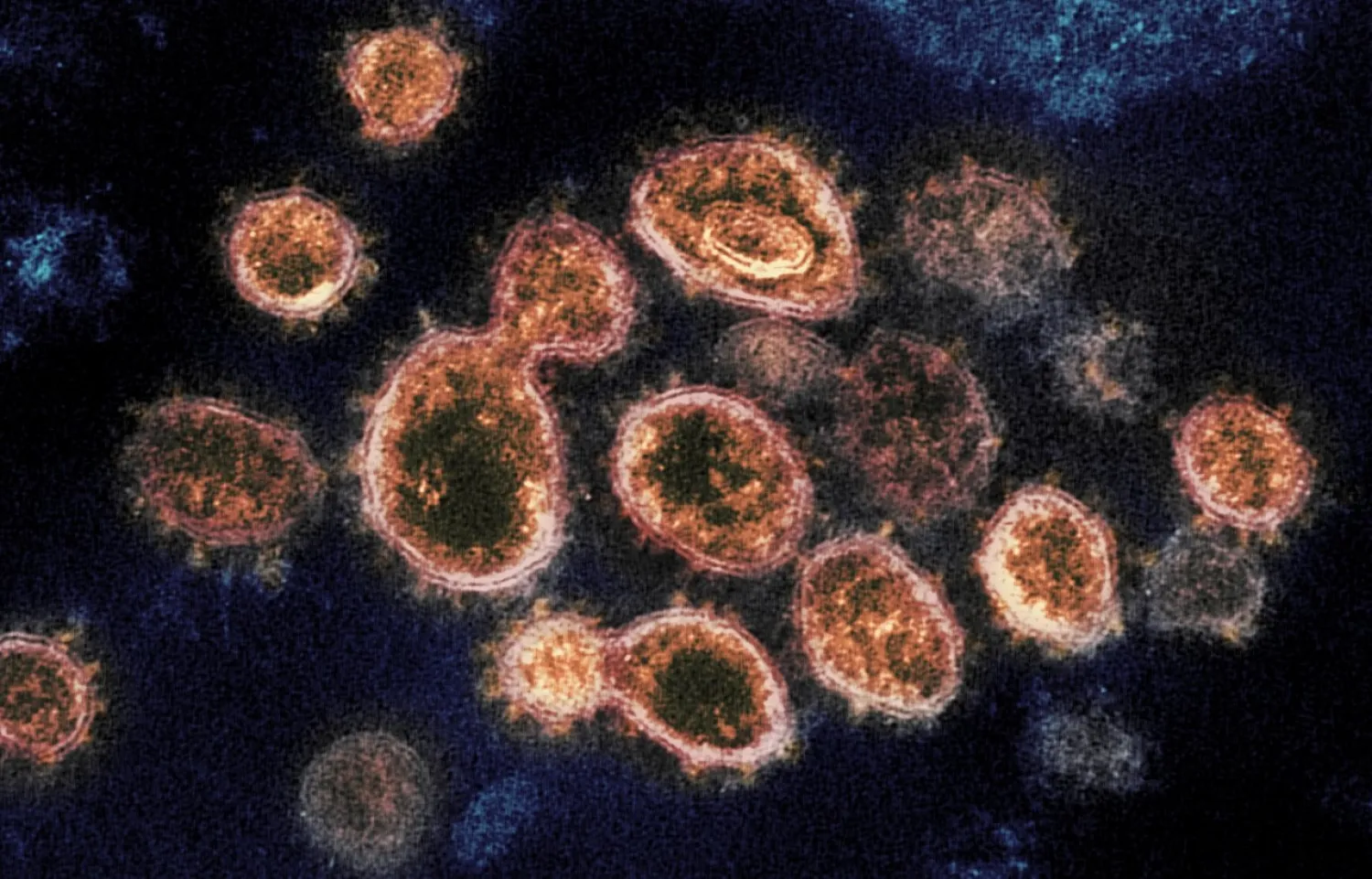 Electron microscope image shows SARS-CoV-2 virus particles which cause COVID-19 (AP)

