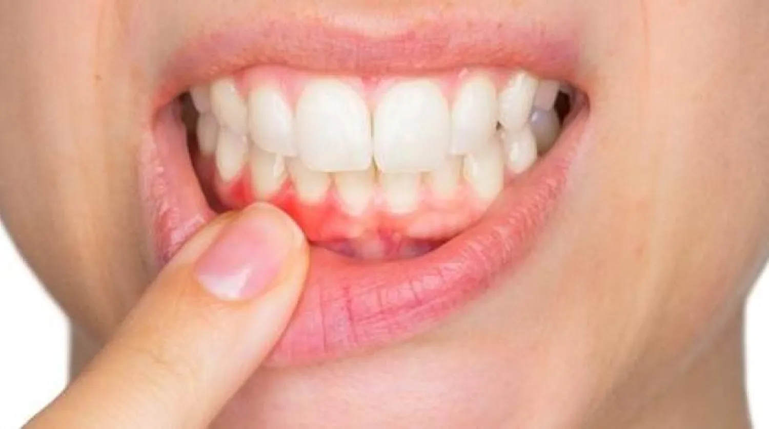 Fazla kiloların neden olduğu iltihaplanma diş eti hastalıklarına yol açıyor