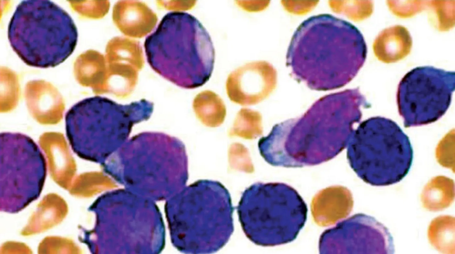 اكتشاف خلايا سرطانية تتهرب من العلاج بالنوم