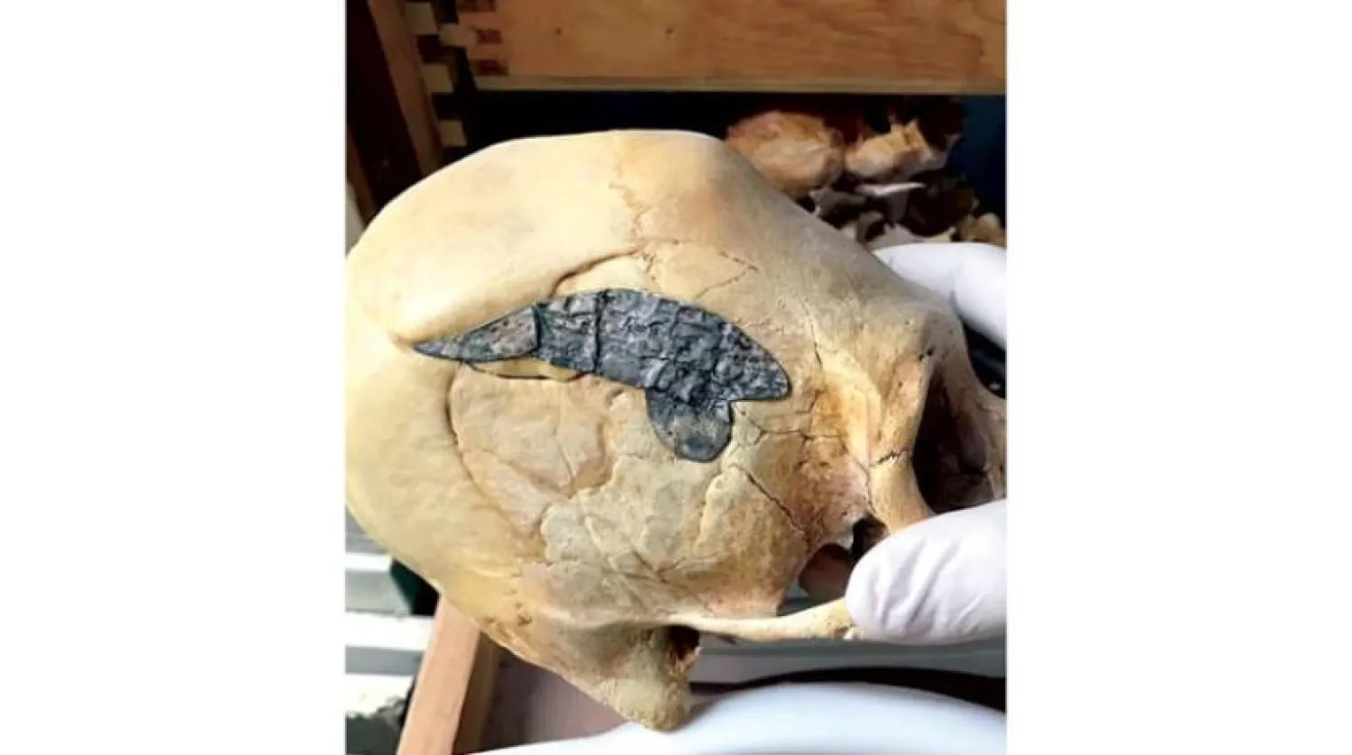 2 bin yıl öncesine tarihlenen Perulu bir savaşçının kafatasındaki metal. (Osteoloji Müzesi)