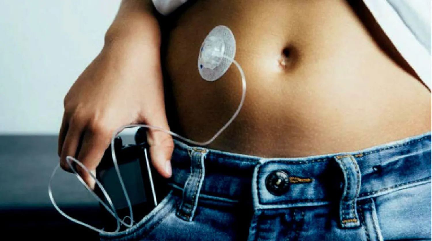 مضخة إنسولين تقليدية للأطفال المصابين بالسكري