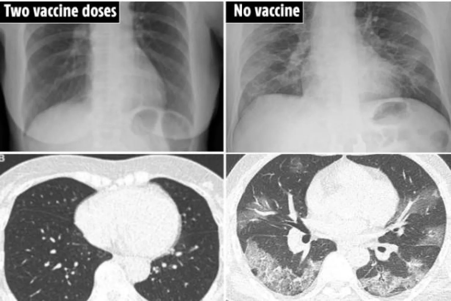 أشعة لمريضة تلقت جرعتي اللقاح (يسار) وأخرى لمريض لم يتلقِ اللقاح تماماً (يمين) (ذا صن)