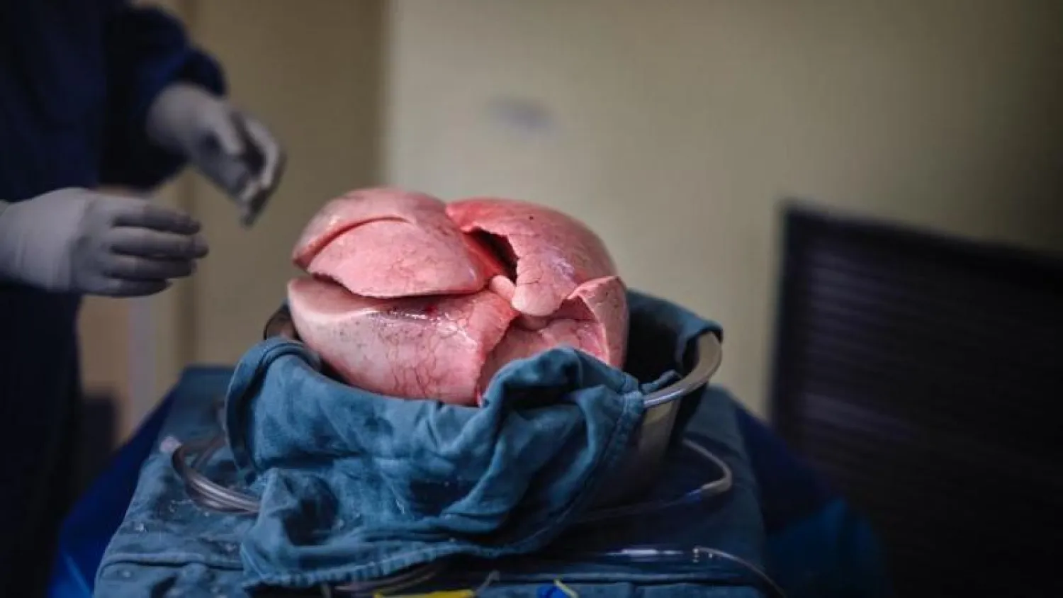 رئتان جاهزتان لعملية زرع في مريض (أ.ف.ب)