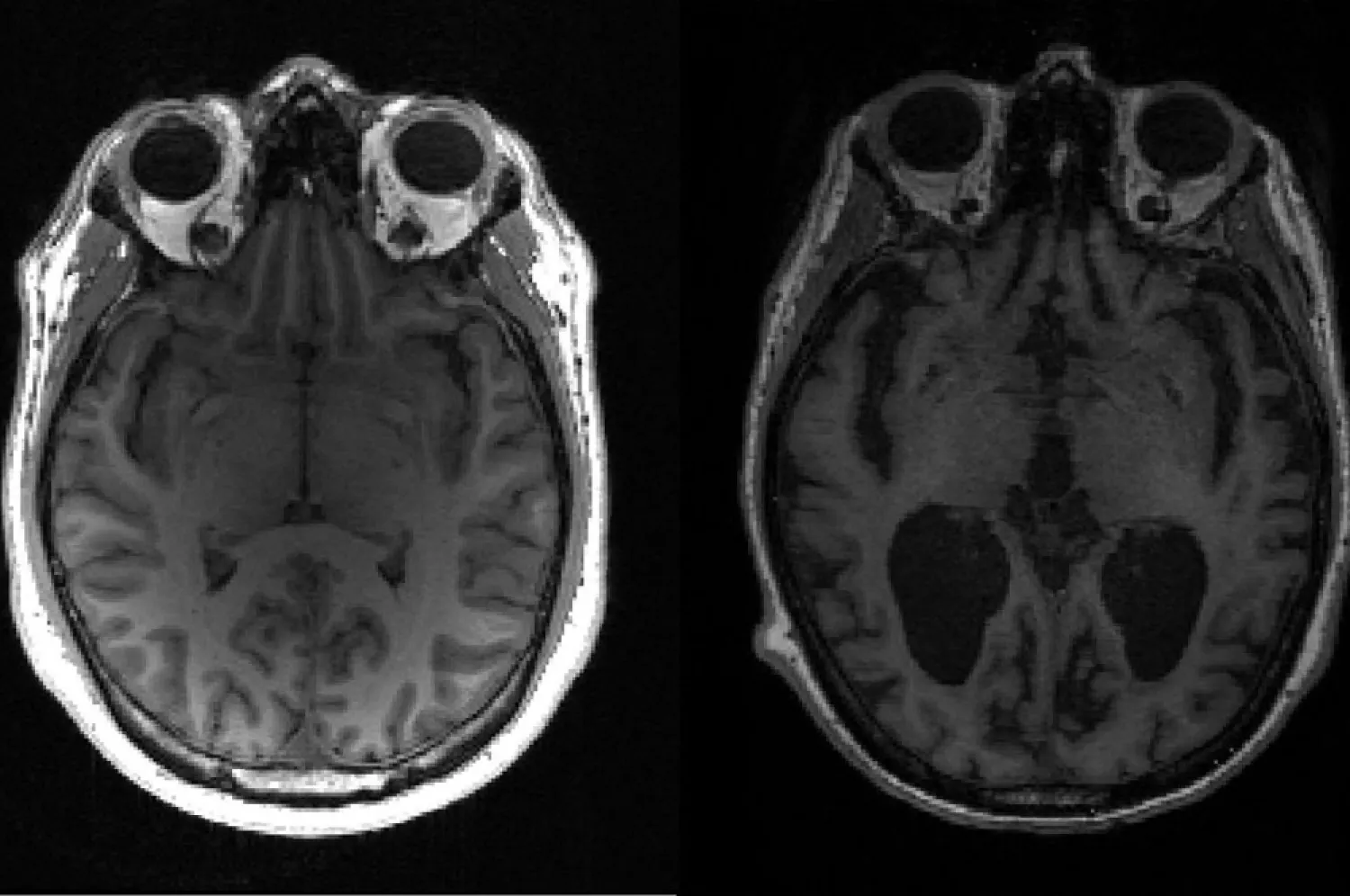 This undated image courtesy of, Dr. Timothy Rittman, University of Cambridge, shows an MRI image of a healthy brain (L) and an Alzheimer's brain (R) with large black gaps where brain has shrunk. (AFP)