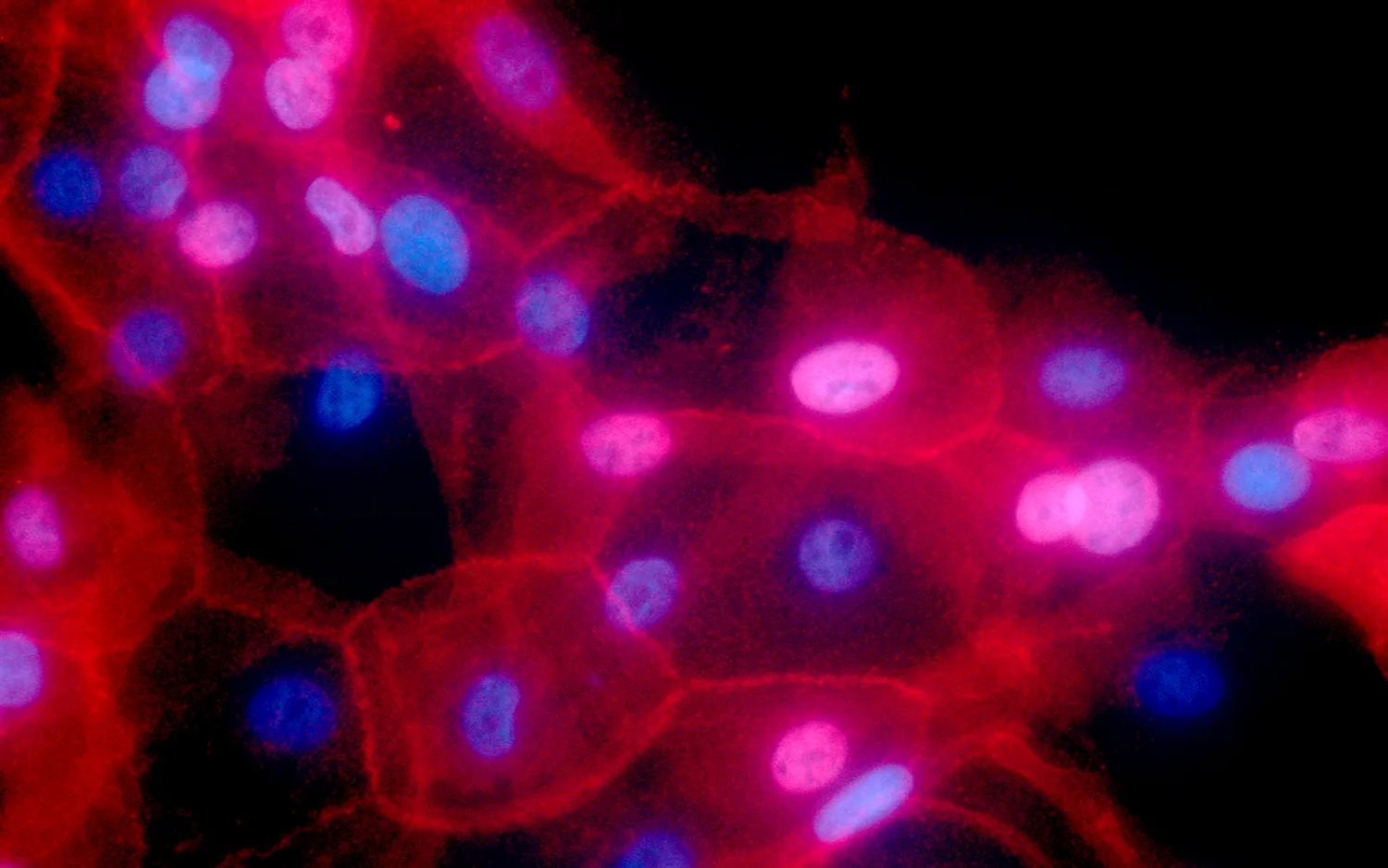 Illustrative image of breast cancer cells. (Ewa
Krawczyk/National Cancer Institute via AP)