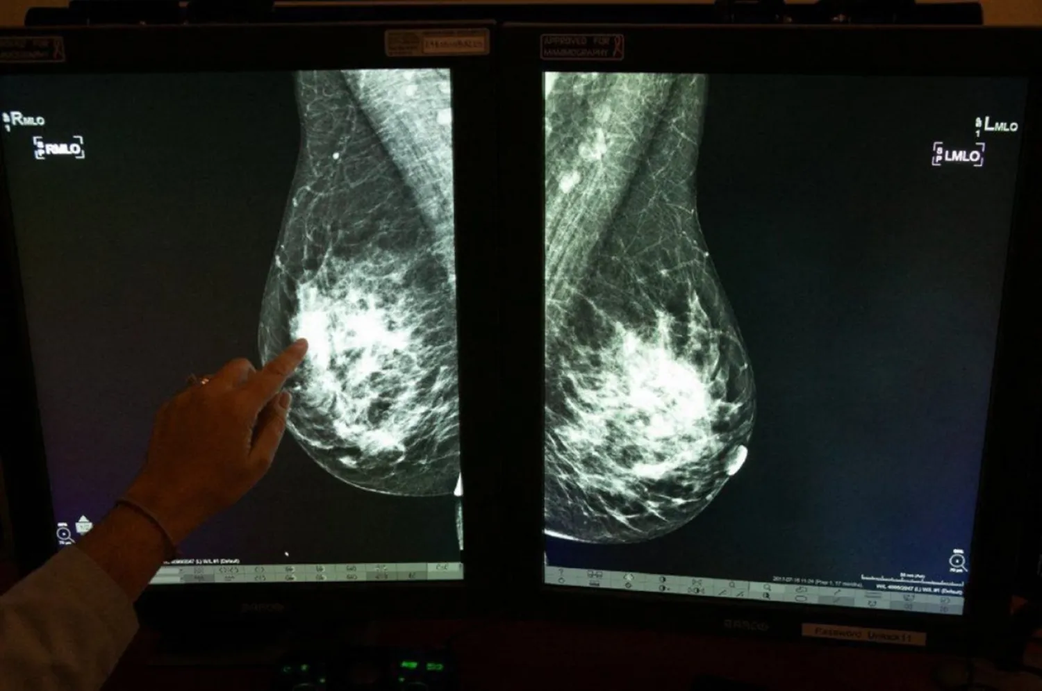Dr. Georgia Giakoumis Spear points to dense breast tissue on a mammogram at Skokie Hospital on December 5, 2018. (via REUTERS)