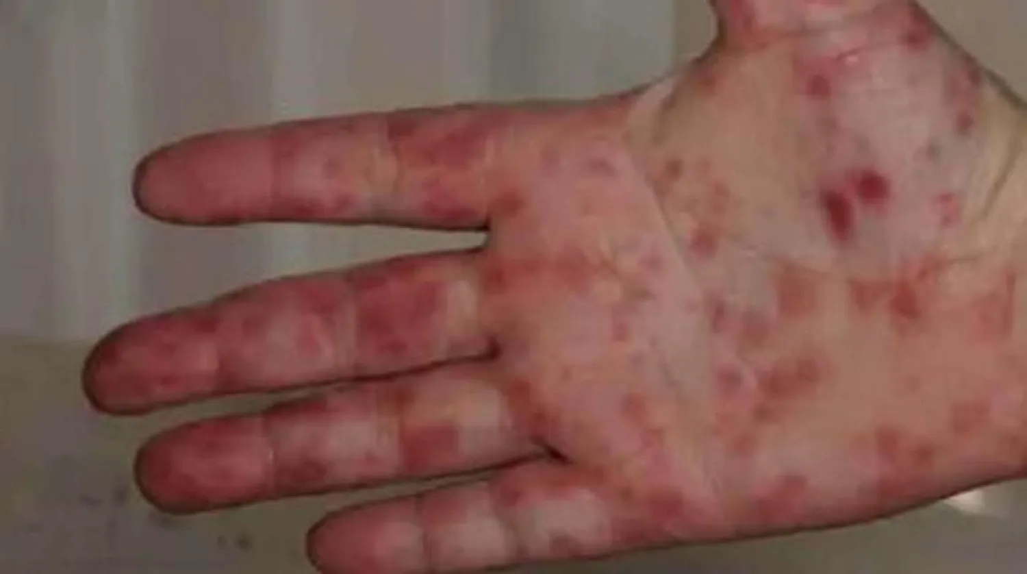 Domates humması olmuş bir çocuğun eli (D.N.A internet sitesi)