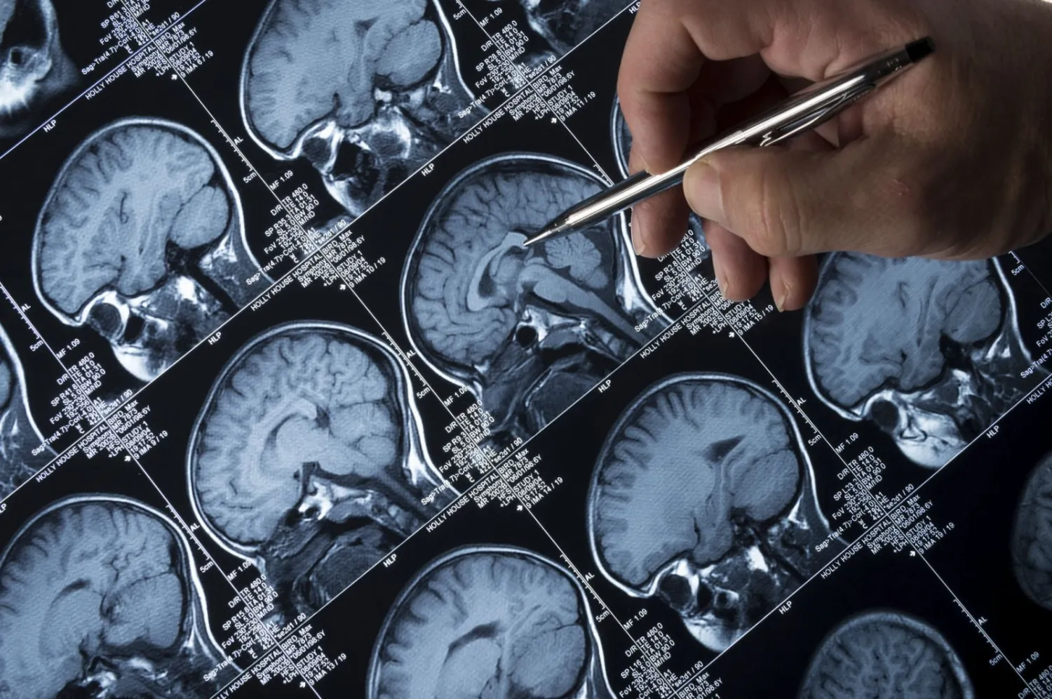 A doctor analyzes the magnetic resonance image (MRI) brain scan of the head and skull of a person. (Getty Images)
