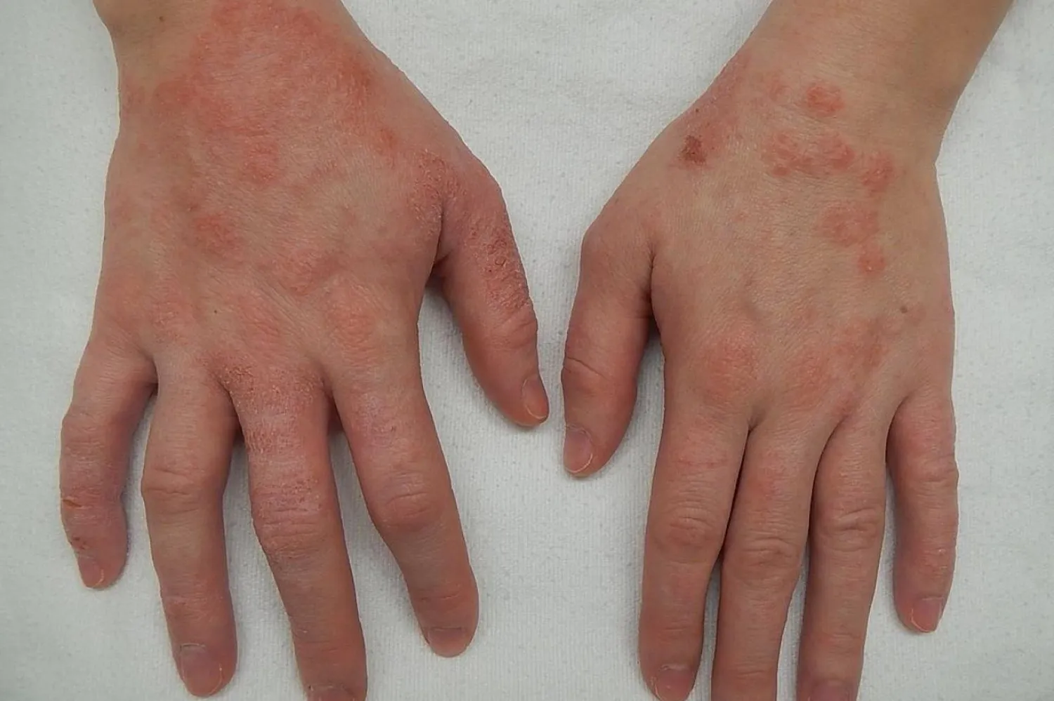 NHS; abrocitinib, upadacitinib ve tralokinumab olmak üzere üç yeni ilaç önerdi (James Heilman, MD/CC-BY-SA-4.0)