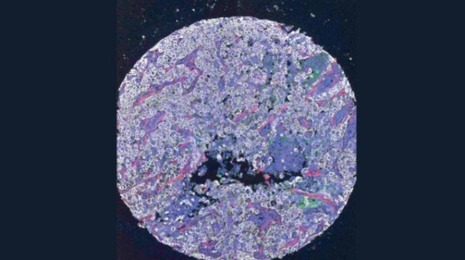 Yeni geliştirilen bir ilaç, kanser vakalarında bağışıklık sistemine ...