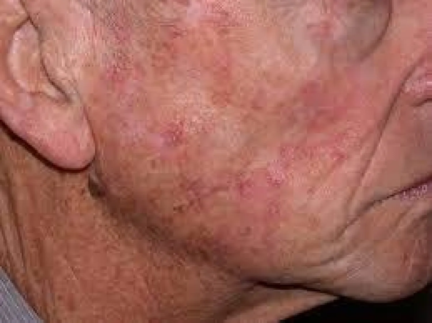 إحدى الحالات المصابة بمرض التقرن الشمسي (موقع كلية الجلدية الأسترالية)