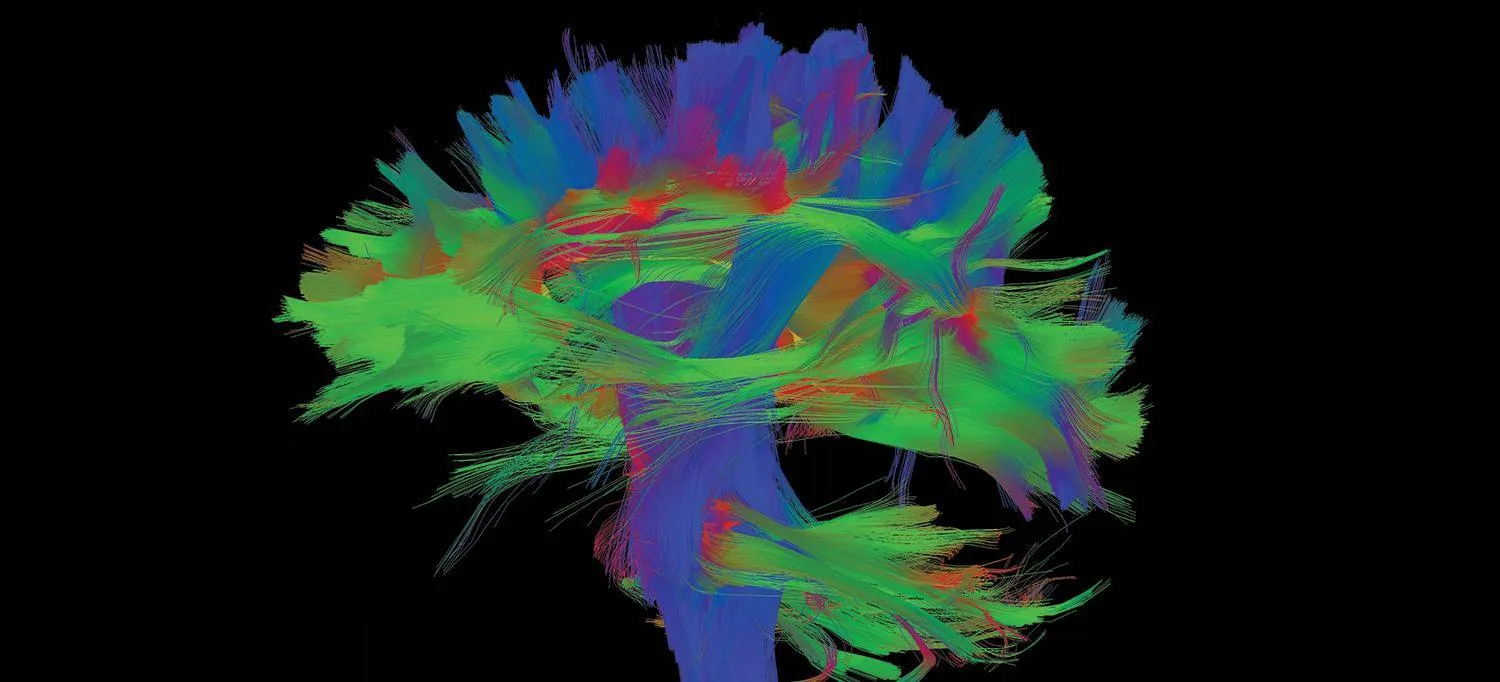 تم استخدام التصوير بالرنين المغناطيسي لإنشاء هذه الخريطة الملونة للمسارات العصبية ( YVONNE W. LUI, MD, AND EYAL LOTAN, MD)