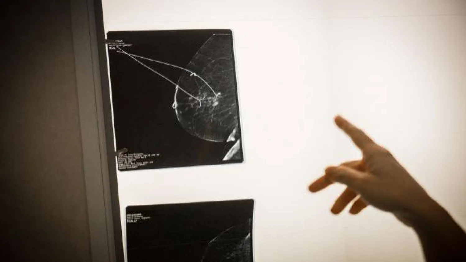 تطوير طريقة جراحية للتوغل السطحي بعلاج الأورام السرطانية