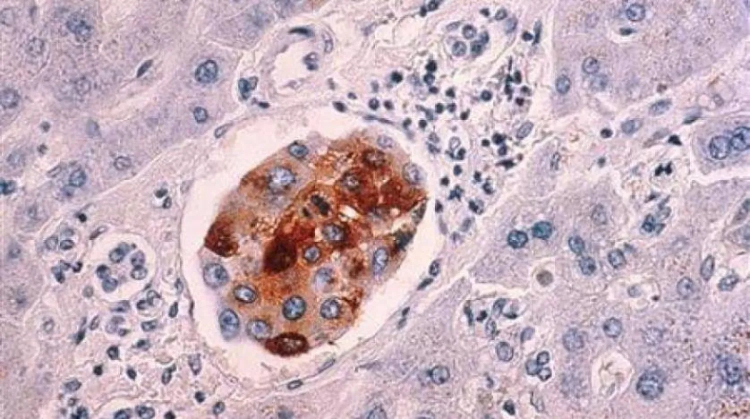 خلايا سرطانية (رويترز)