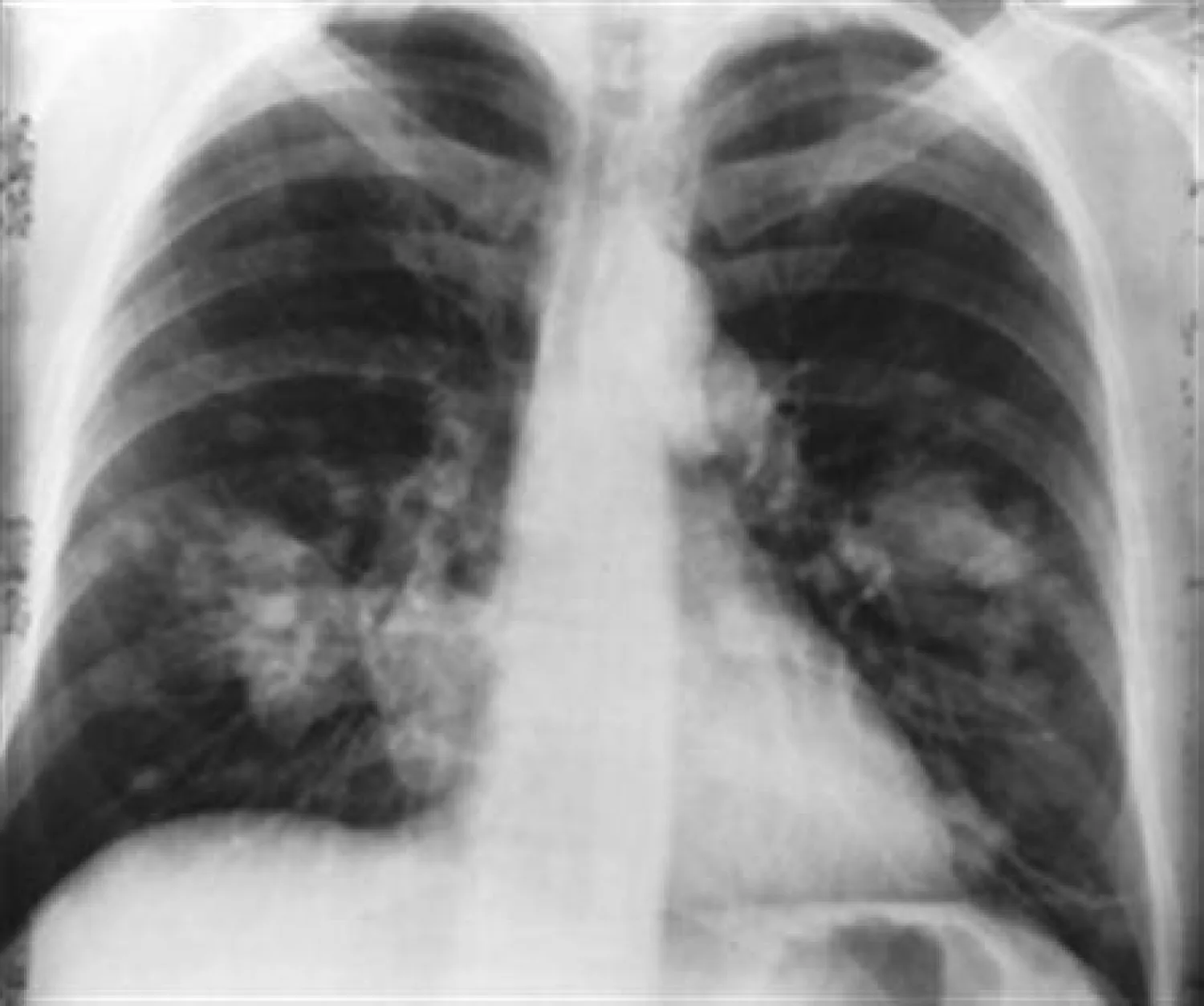 دراسة: بروتين «مثبط ورم شهير» له دور بارز بإصلاح الأنسجة