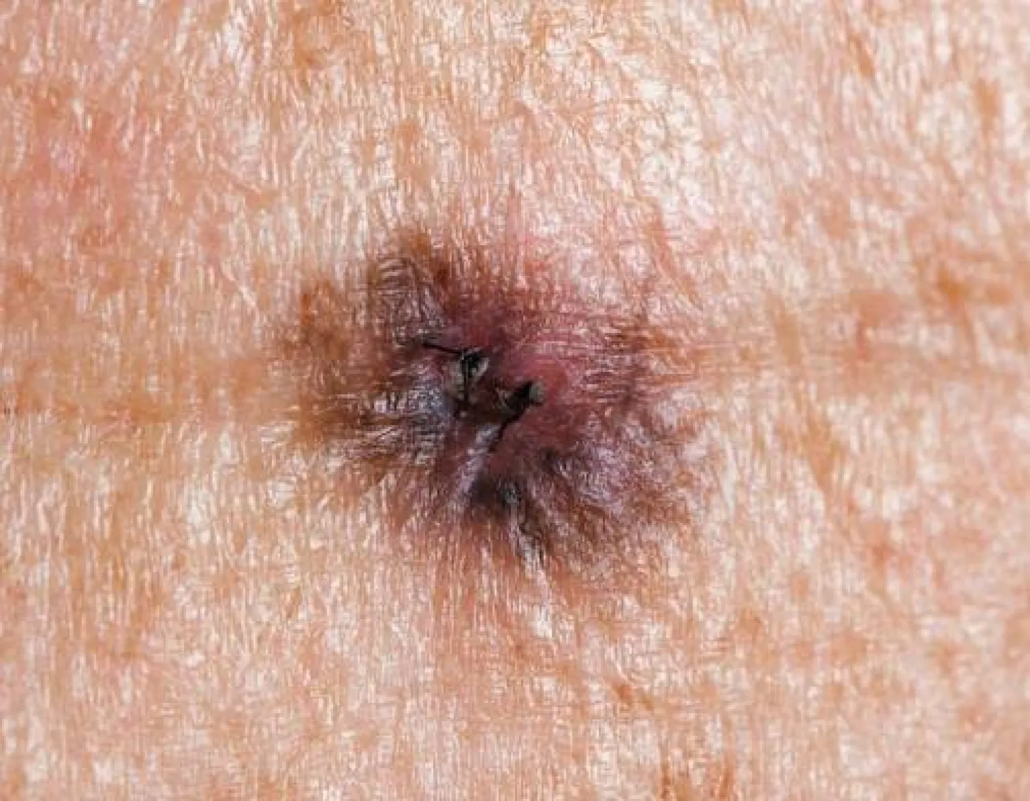 ابتكار جهاز يكشف سرطان الجلد بمرحلة مبكرة