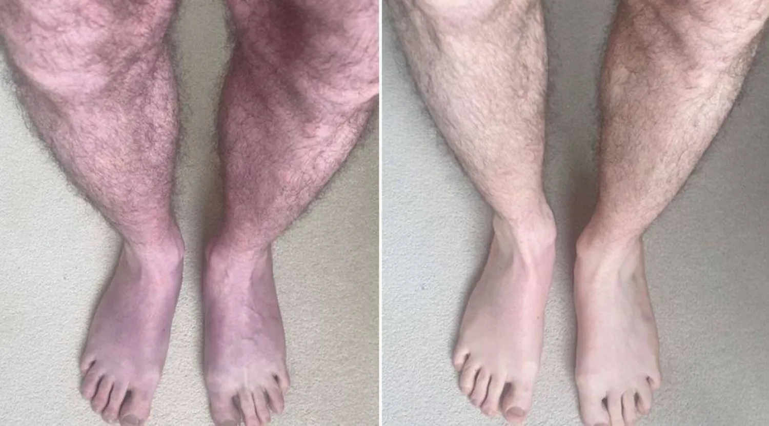 صورة نشرها فريق جامعة ليدز لساقي الرجل